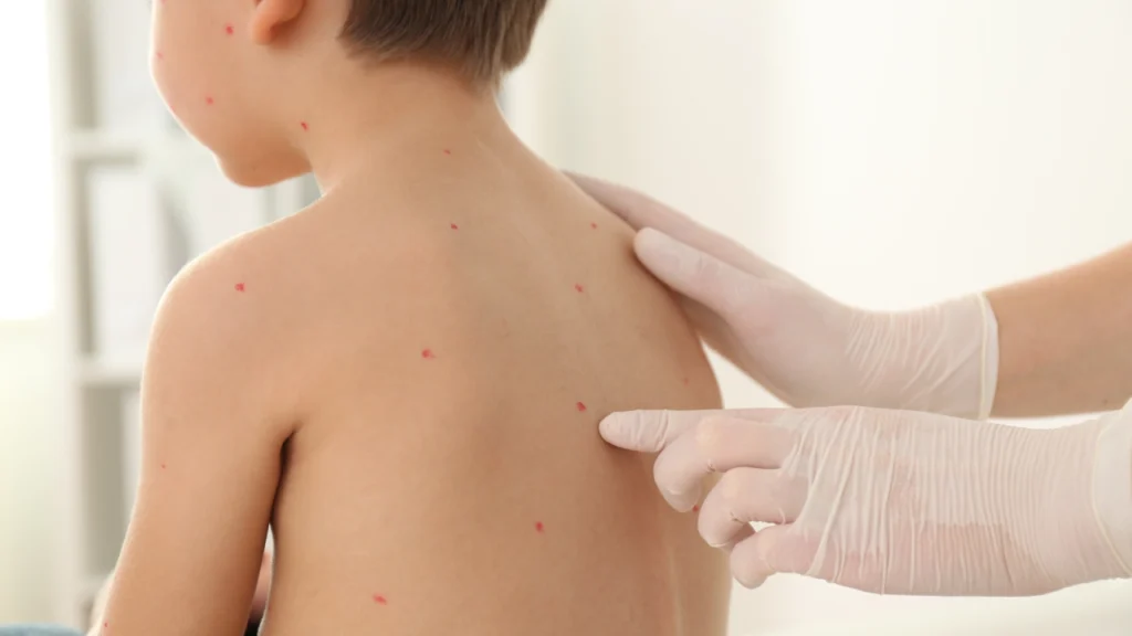 Uşaqlarda su çiçəyi əlamətləri